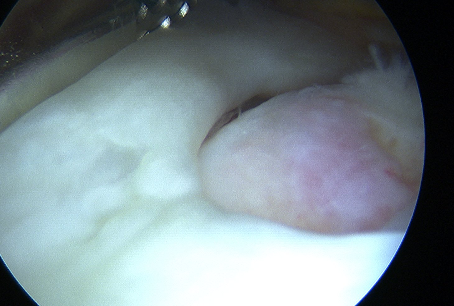 SS tear arthroscopy